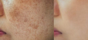 Pigmentation-before-and-after-1080x490